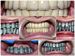 Punti metalo-ceramice total fizionomice pe implanturi maxilar si mandibular - ceramica d'Sign Ivoclar