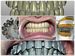CAD-CAM (selective laser melting) fixed dental prosthetic bridge  on implants abutments