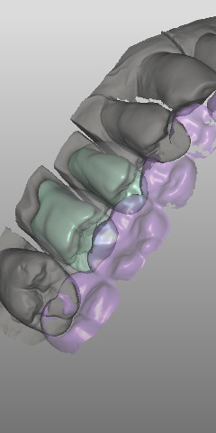 Computer assisted design of dental prosthetics